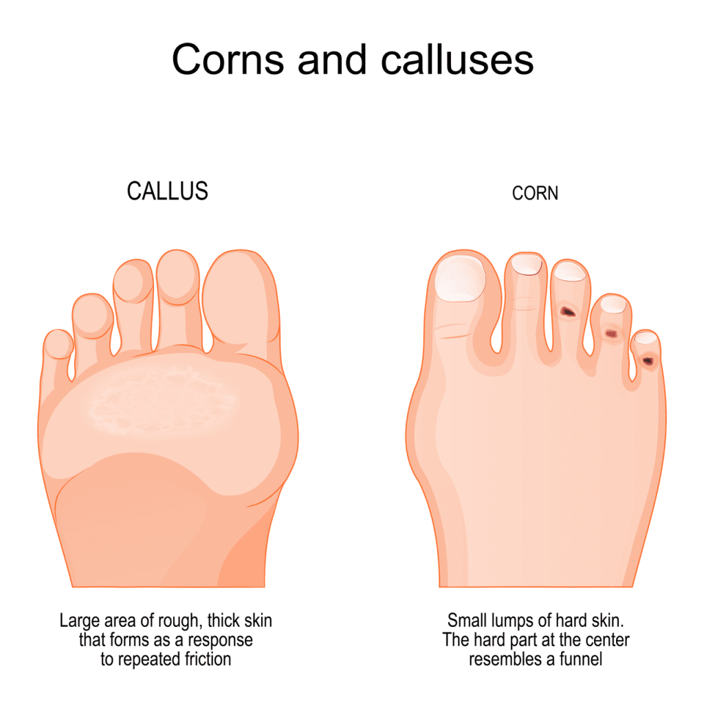 Corns Calluses Nova Family Podiatry
